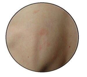 eczema on the back
